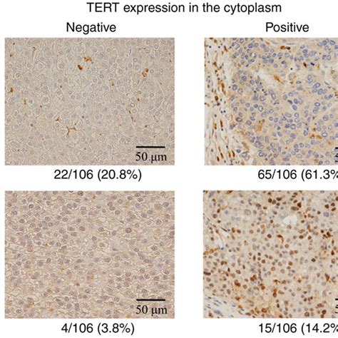 Immunohistochemistry Of Hepatocellular Carcinoma Tumors With A Mouse