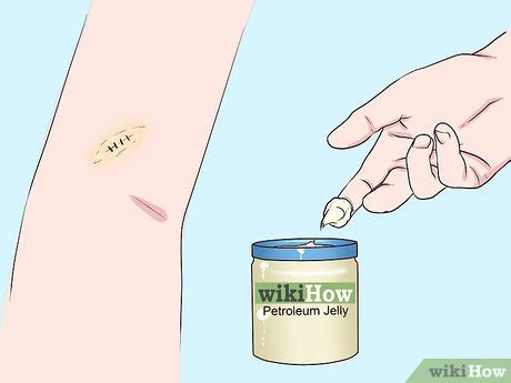 3 Ways to Undergo a Mole Biopsy - wikiHow