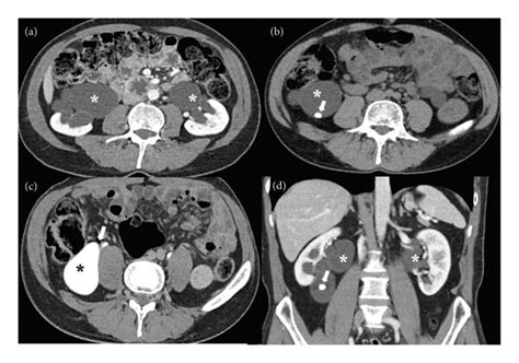 An Adult Case Of Severe Asymptomatic Bilateral Ureteropelvic Junction Obstruction Hossain