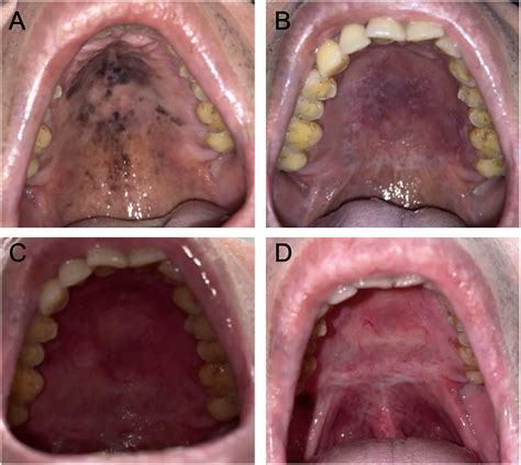 Topical Imiquimod Effectiveness In Intraepithelial Off