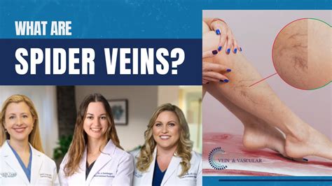 Understanding Spider Veins Causes Symptoms And Treatments La Jolla