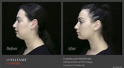 Enhance Neck And Jawline Myellevate Minimally Invasive Jawline