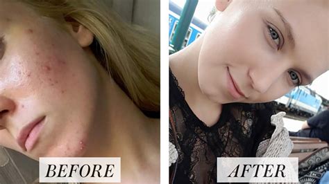 Woman S Before And After Accutane Photos Go Viral On Reddit Allure