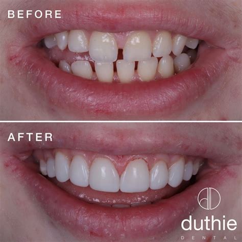 What Is Composite Bonding Before And After Teeth Examples