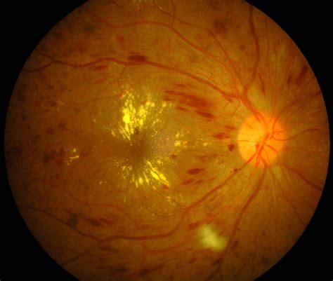 Retinopatia Diabética saiba o que a diabetes pode estar fazendo em