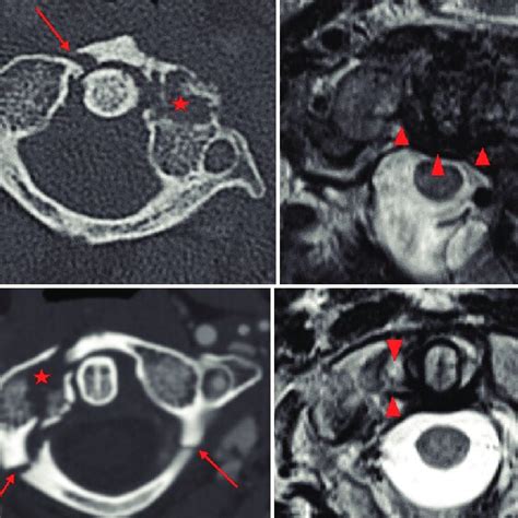 A Axial Ct Of The Cervical Spine Left In A Year Old Trauma