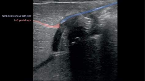 Ultrasound Guided Uvc Umbilical Venous Catheter Malposition Kozyak