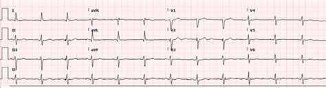 Repeat Electrocardiogram Demonstrating Resolution Of St Elevations In