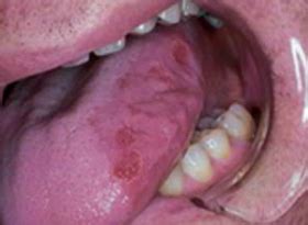 Early Tongue Cancer Pictures PictureMeta