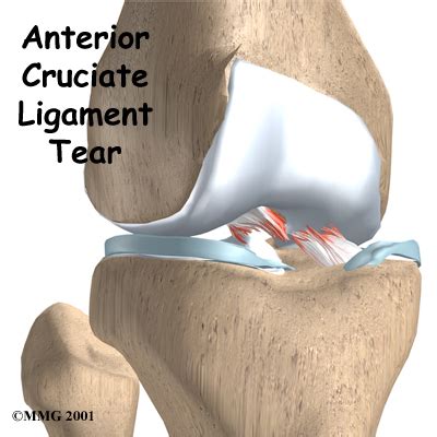 (ACL Injury) Anterior Cruciate Ligament Tear Symptoms & Surgery