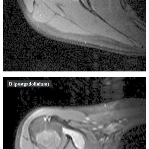 Sinovite vilonodular pigmentada Proliferação nodular e vilosa cabeças