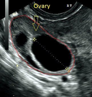 Pelvic Ultrasound Scans for Women in London - Ultrasound Services