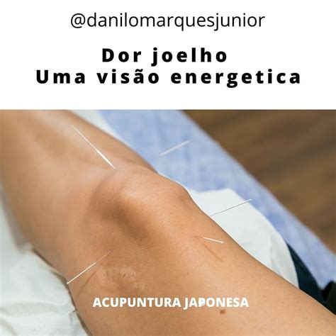 Danilo Marques Junior On Instagram A Acupuntura Um Excelente Meio