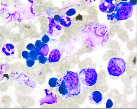 Bone Marrow Smear Showing Erythro Phagocytosis Wright Stain 1000