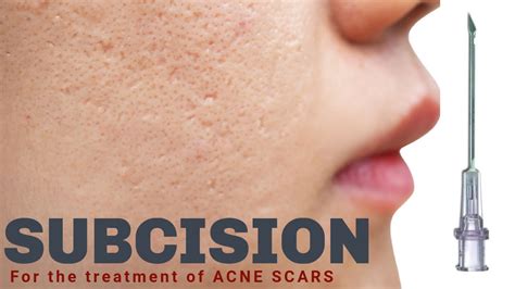 Subcision For Acne Scars Advanced Dermatology And Laser Institute Of