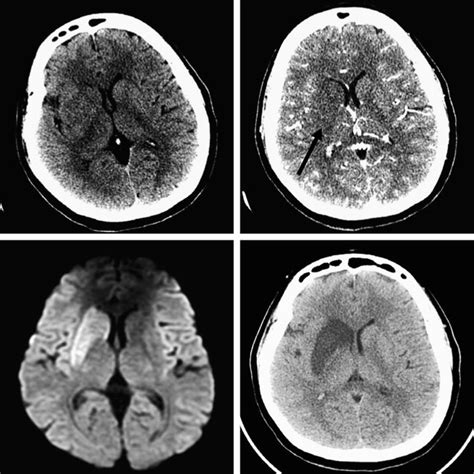 Ct Perfusion Imaging In Acute Stroke Neuroimaging Clinics