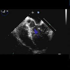 A Short Axis View Transesophageal Echocardiography At The Level Of