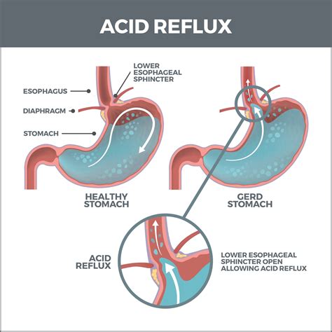 Stomach Acid Diagram