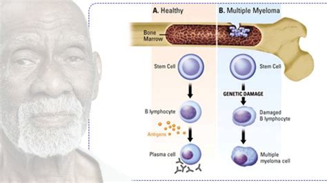 myeloma advocates  dr sebi
