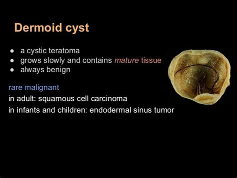 Teratoma