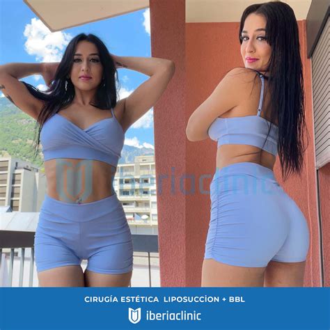 Operación Bikini Para Hombres İberia Clinic