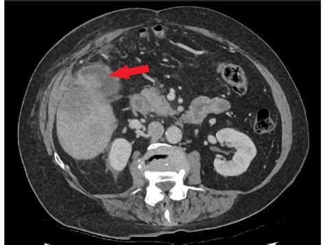 Abnormal Soft Tissue Mass In Gallbladder Lumen See Arrow And