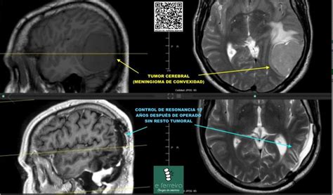 TUMOR CEREBRAL Dr Edgar Ferreira Neurocirujano