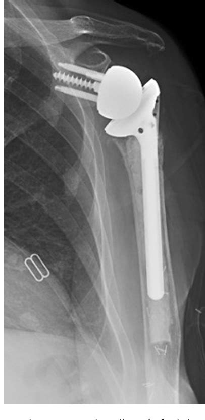 Figure From Tumoral Calcinosis Complicating A Reverse Total Shoulder