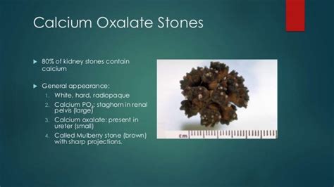 Calculus Disease Renal Stones Radiology