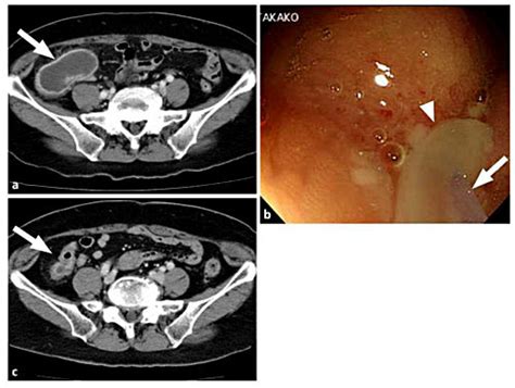 Appendicitis Abscess