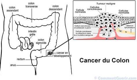 Cancer Du Colon