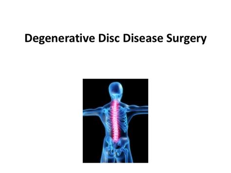 Degenerative Disc Disease Surgery