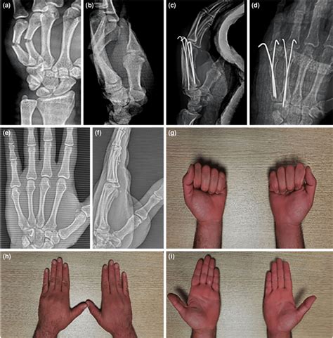 Preoperative A Pa And B Lateral X Rays Of The 4 Th And 5 Th