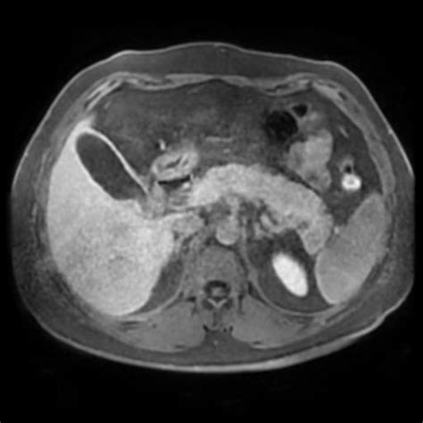 Intrapancreatic Accessory Spleen Image