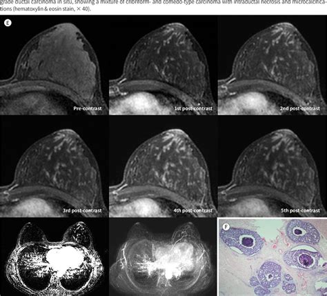 Figure 1 From An Unusual Presentation Of Extensive Ductal Carcinoma In