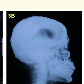 A: CT scan of brain shows pneumocephalus development that involves... | Download Scientific Diagram