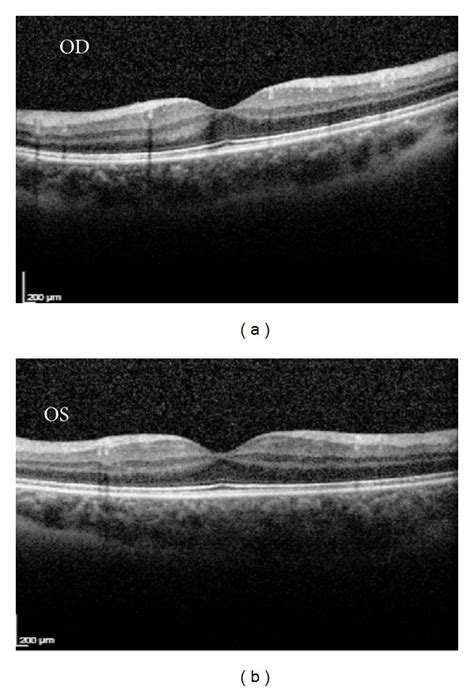 Optical Coherence Tomography Of The Macula Without Any Abnormal Findings Download Scientific