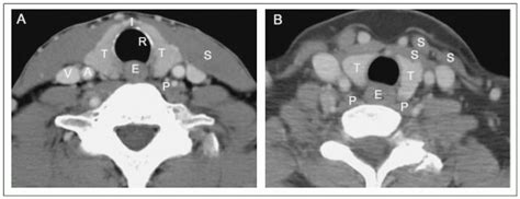 Thyroid | Oncohema Key