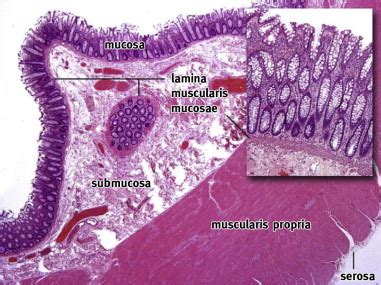 Colon Cancer Histology Images - Pathology Outlines Adenocarcinoma ...