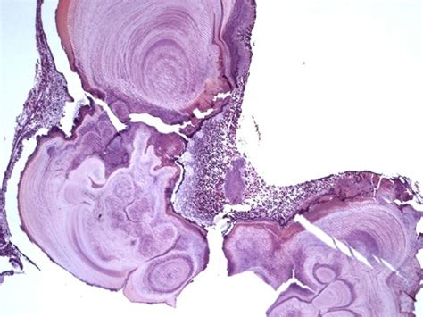 Scielo Brasil Sialolithiasis Of Minor Salivary Glands