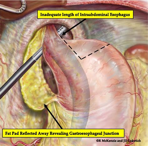 Hernia Repair Surgery