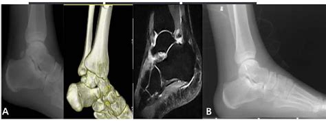 Figure 4 From Safety And Clinical Efficacy Of Double Posterolateral