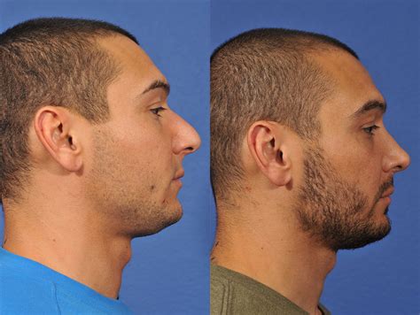 Rhinoplasty Before After