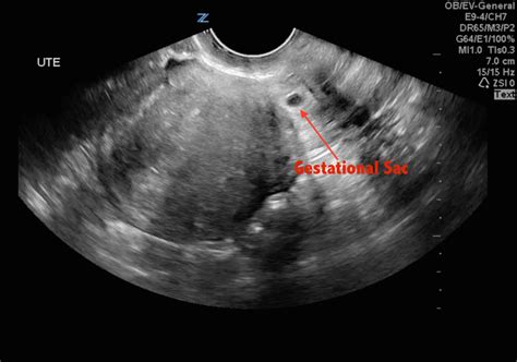 Hennepin Ultrasound Cesarean Scar Ectopic