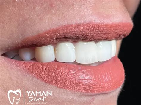Teeth Whitening Turkey: Price & Procedures | Yaman Dent