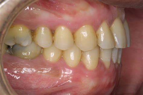 Melanosis Gingival Tratamiento Cl Nica Dental Bilbao