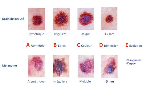 Comment Surveiller Ses Grains De Beaut