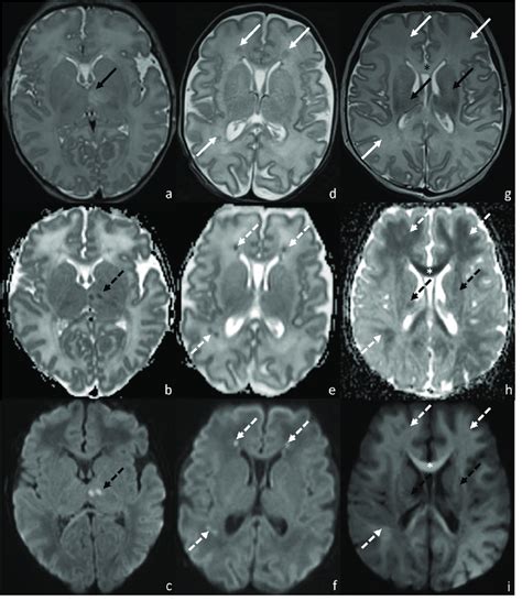 Mri Of Patients Affected By Hie Injury And Presenting Pattern