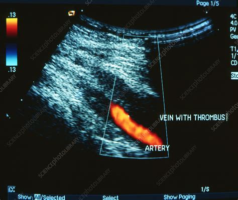 What Does A Dvt Look Like On Ultrasound At Charles Braim Blog