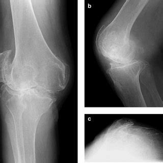 Preoperative Plain Radiographs A Anteroposterior View Demonstrating